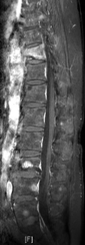 breast camcer T-L spine metastasis